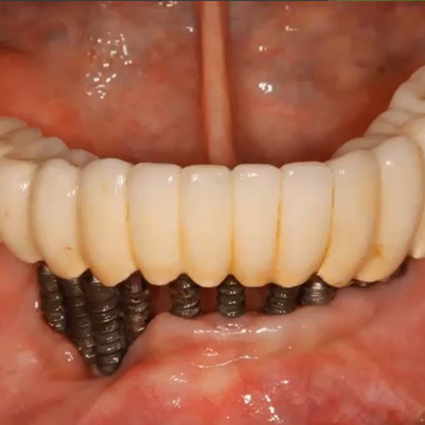 Implants Slide_2 Implants Slide_2