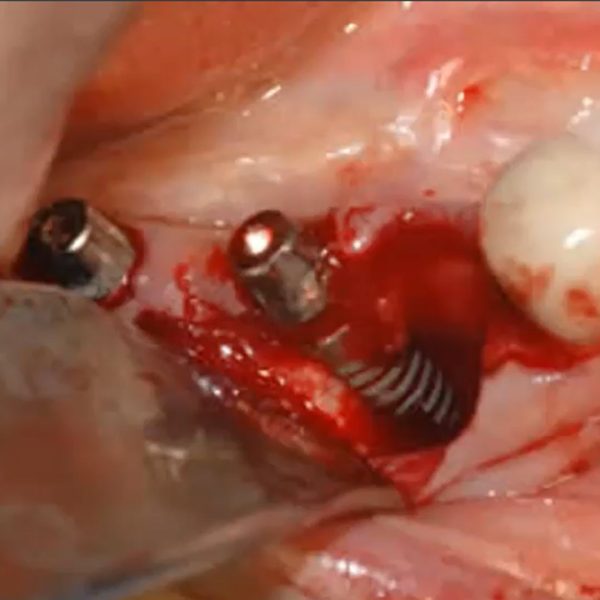 Implants Slide_3 Implants Slide_3