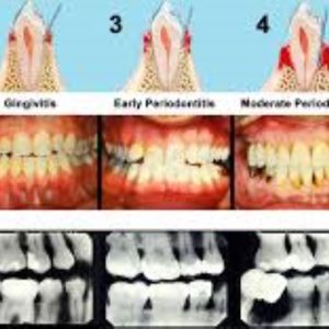 Down and Dirty - Staging and Grading Periodontal Patients