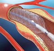 Treating Patients with the Latest Advancements in Cardiovascular Stents