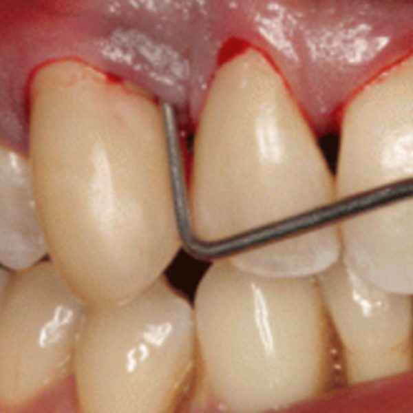 advanced_periodontal_disease_1000 x 1000